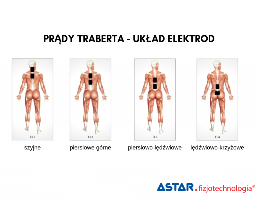 Prąd Traberta - układ elektrod
