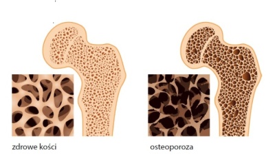 osteoporoza pl