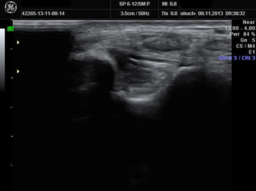 Ryc. 3. Obraz zmian bliznowatych więzadła piszczelowo-piętowego po serii zabiegów