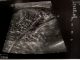 Obraz USG - uraz - naderwanie mięśnia brzuchatego łydki