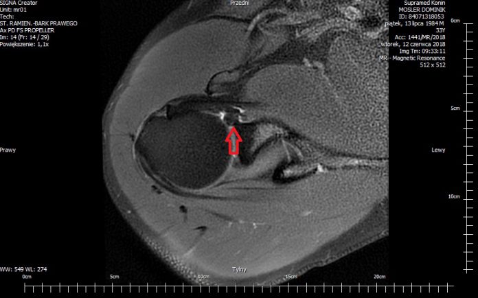 Uszkodzenie obrąbka stawowego w części górnej (SLAP II), krwiak w obrębie przyczepu bliższego m. podłopatkowego - leczenie urazu stawu barkowego
