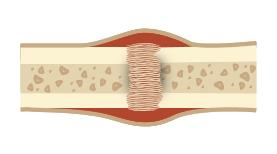 Faza zrostu kości obraz poglądowy - ultradźwięki o niskiej intensywności