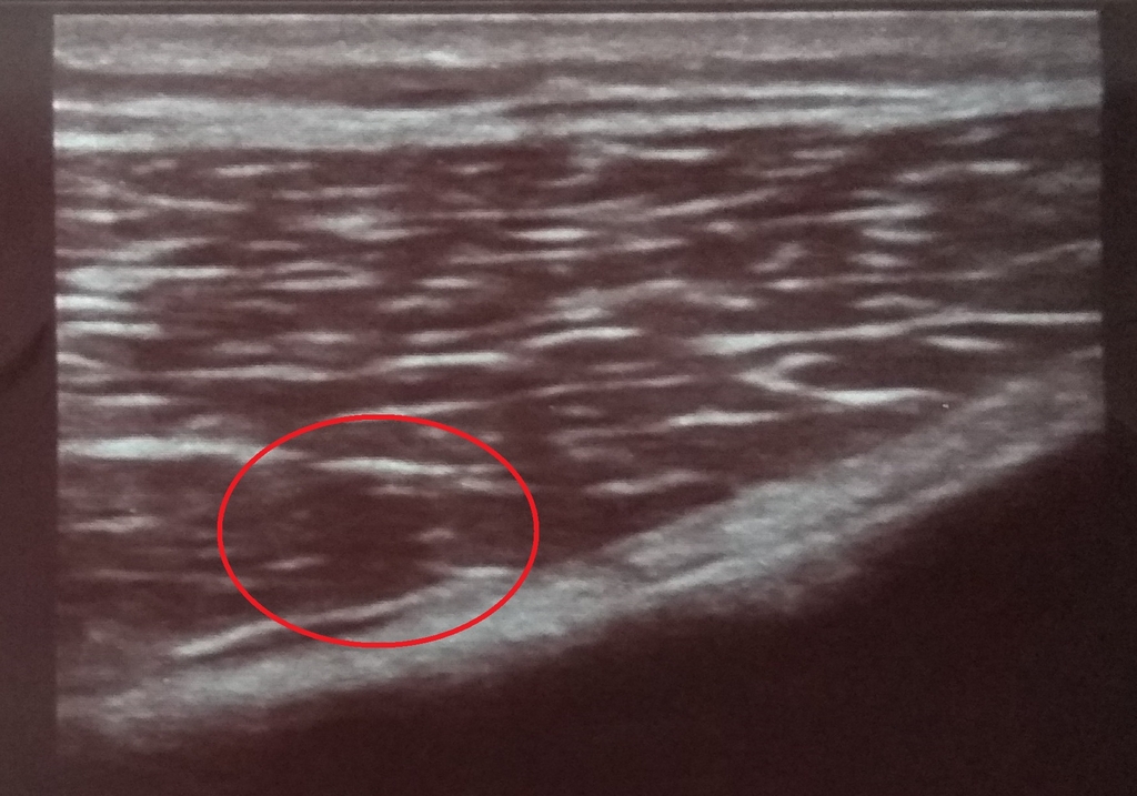 Obraz USG - naderwanie mięśnia czworogłowego uda - po 3 tyg terapii