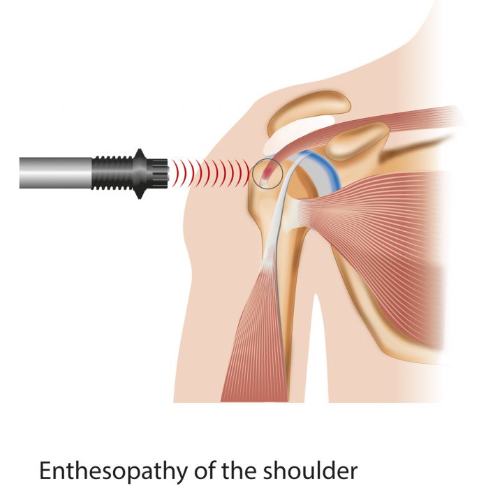 Enthesopathy of the shoulder treated by shockwave